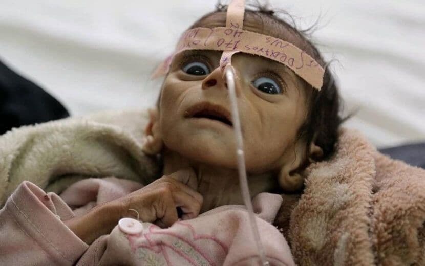 Yemen’deki Kolera Salgının Bilançosu Ağırlaşıyor